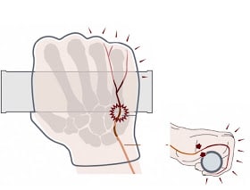 adormecimiento en las manos sobre la bicicleta